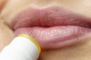 Causes and remedies for chapped lips