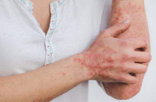 How to Recognize Psoriasis